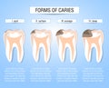 Caries stages of development. Visual aid for students, dentists, clinic patients. Defeat the source of destruction in the teeth. V